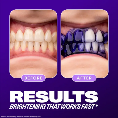 Purple Teeth Whitening Serum – Instant Color Correcting Smile Booster