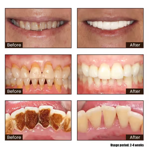 7-Pro Intensive Whitening Toothpaste – Purple Formula with 7 Probiotics for a Brighter, Fresher Smile